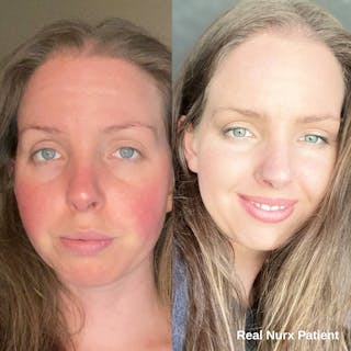 Side-by-side comparison of a woman's face before and after using Azelaic Acid treatment. The left image shows redness, while the right image reveals clearer skin. The text reads 