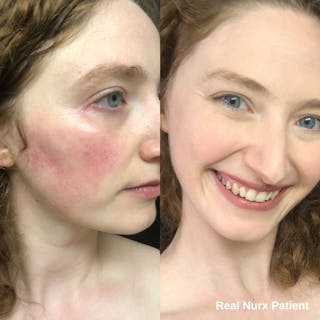 Side-by-side images of a woman showing skin improvement. Left: Redness on cheek; right: Clear skin with a smile, thanks to Azelaic Acid. Text: 