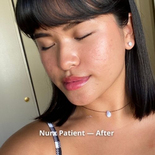 acne after treatment