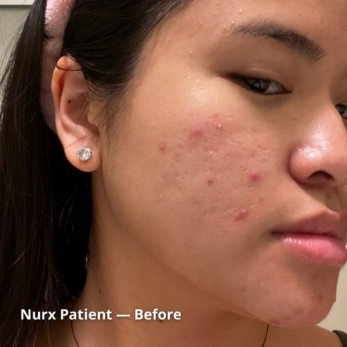 acne before treatment