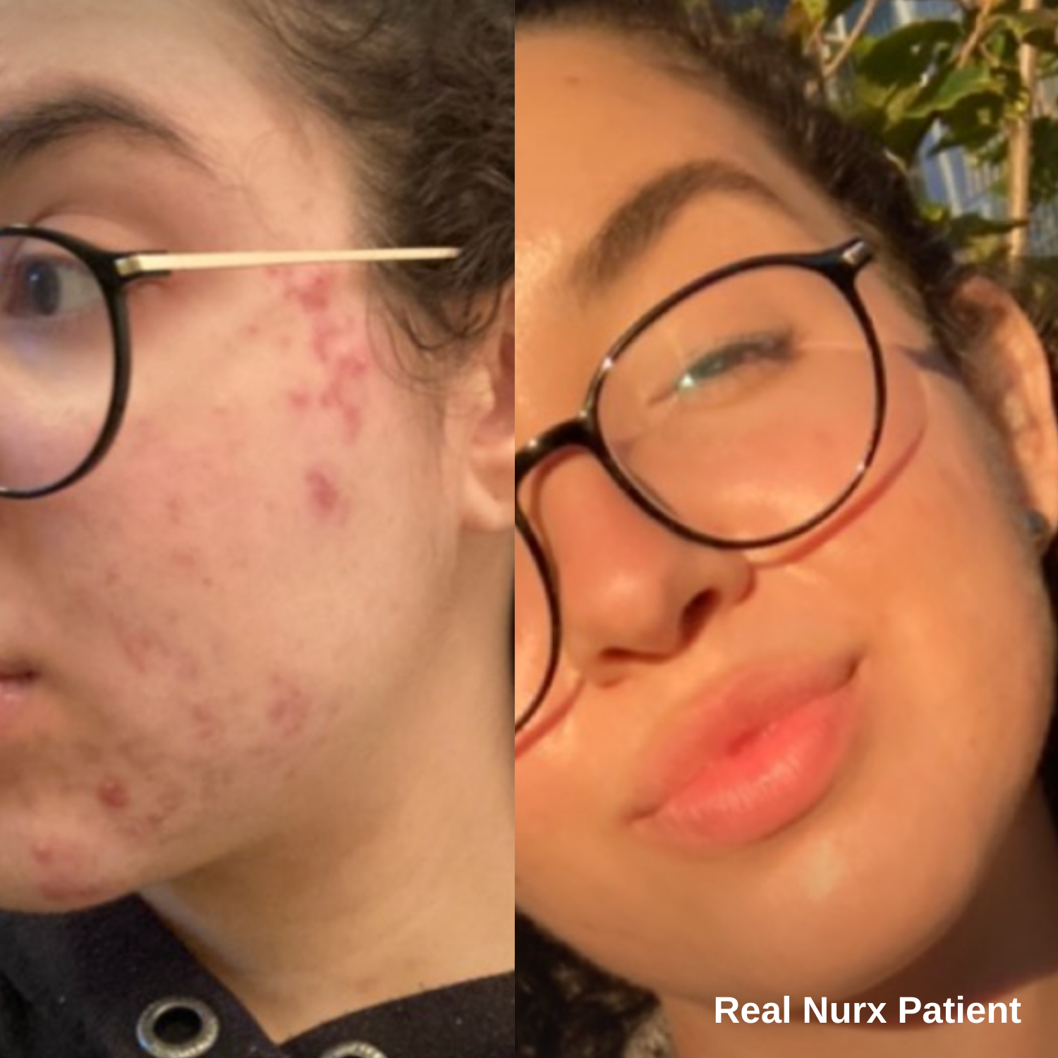 Split image showing a woman's face before and after acne treatment with Tretinoin Cream, highlighting improved skin clarity on the right. The text reads: 