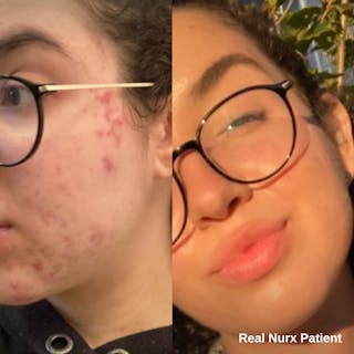 Split image showing a woman's face before and after acne treatment with Tretinoin Cream, highlighting improved skin clarity on the right. The text reads: 