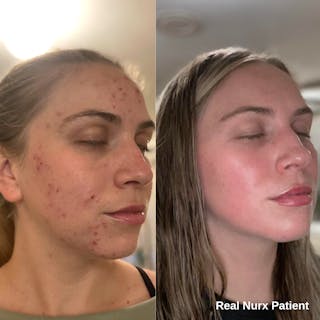 Side-by-side images showing a person's face before and after acne treatment with Tretinoin Cream. The left side reveals acne, while the right side showcases clearer skin. Text: 