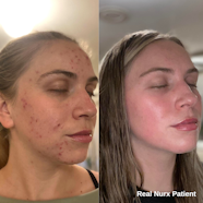 Tretinoin Cream 025 Retin A For Acne Nurx 