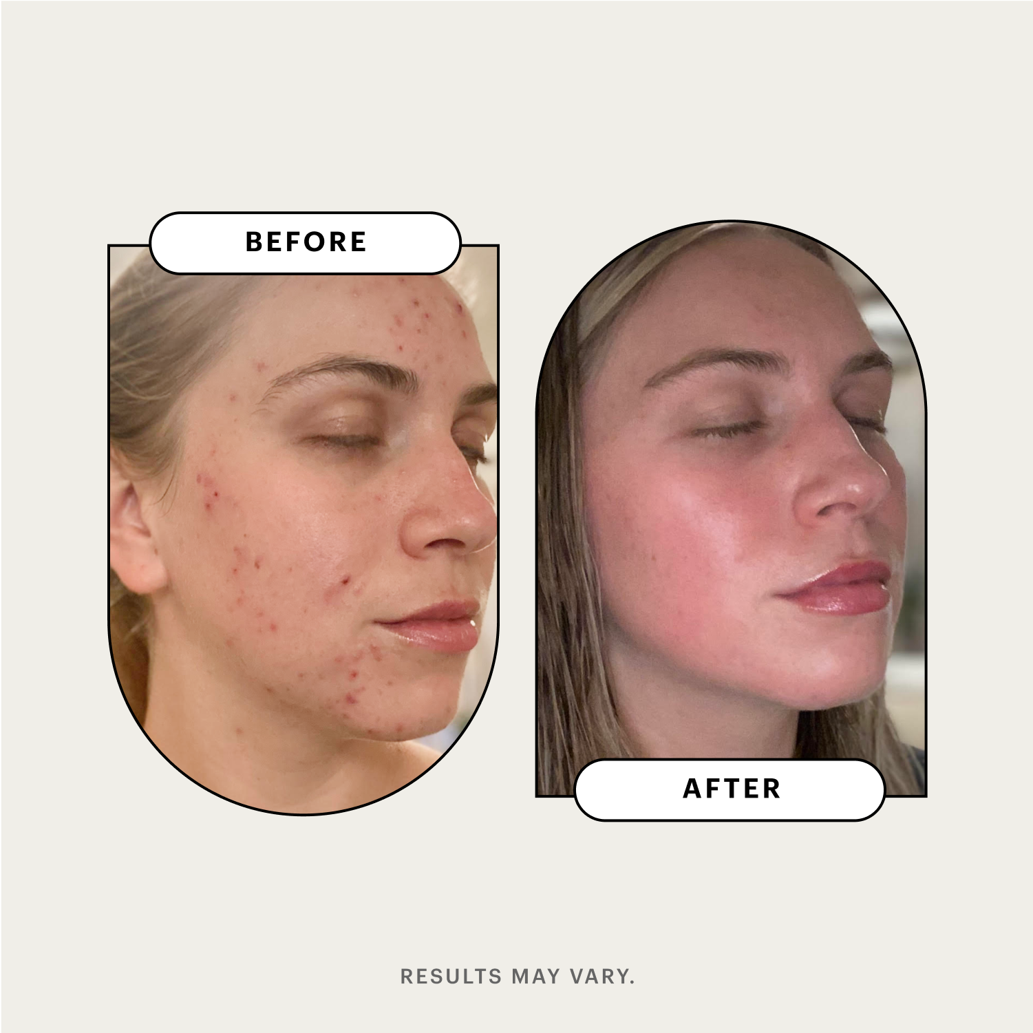 Side-by-side images showing a woman's face before and after treatment for acne with Clindamycin, highlighting visible improvement in skin texture and clarity.