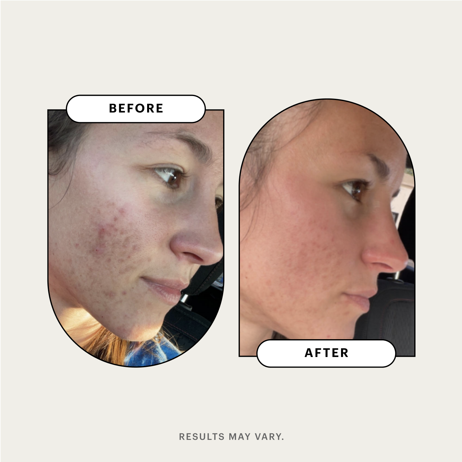 Side-by-side comparison of a woman's face before and after a clindamycin skincare treatment, showing reduced acne and smoother skin. Results may vary.