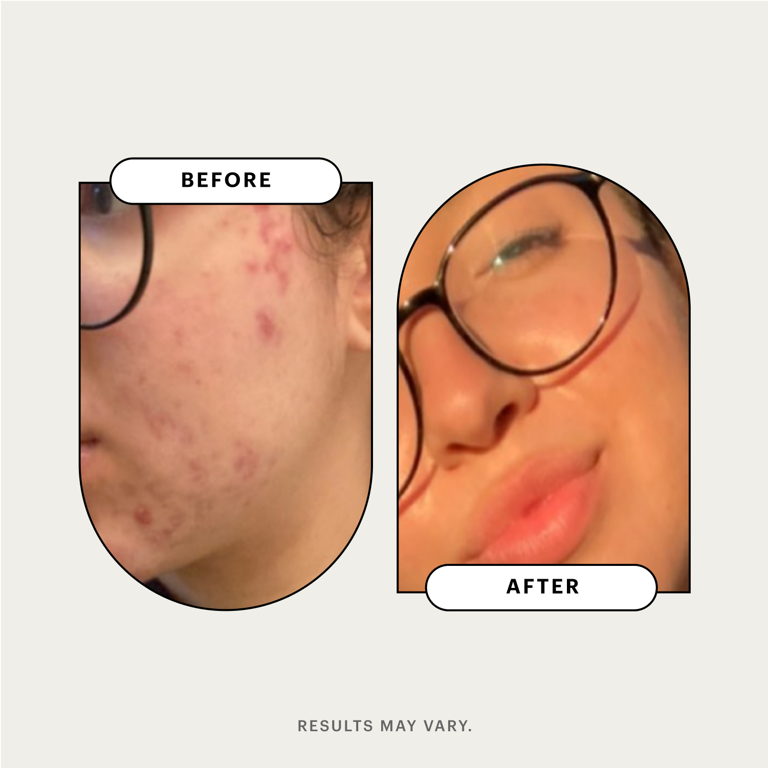 Side-by-side images reveal a close-up of a person's cheek before and after incorporating clindamycin into their skincare routine, highlighting remarkable changes in skin clarity.