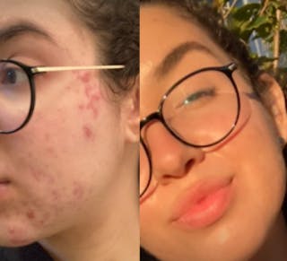 Side-by-side comparison of a person with acne on the left and clearer skin on the right, highlighting the transformative effects of Tretinoin Cream. Both images show the person wearing glasses and facing the camera, showcasing their journey towards healthier skin.