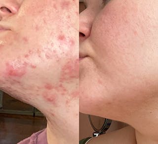 A split image, the left side showing a face with severe acne and the right side showing a face with clear skin