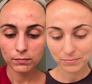 A split image, the left side showing a face with moderate acne and the right side showing a face with clear skin