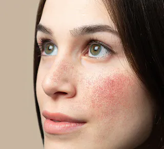 Rosacea