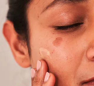 Melasma