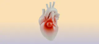 glp-1 heart palpitations Agonists and Rate How to stop heart palpitations